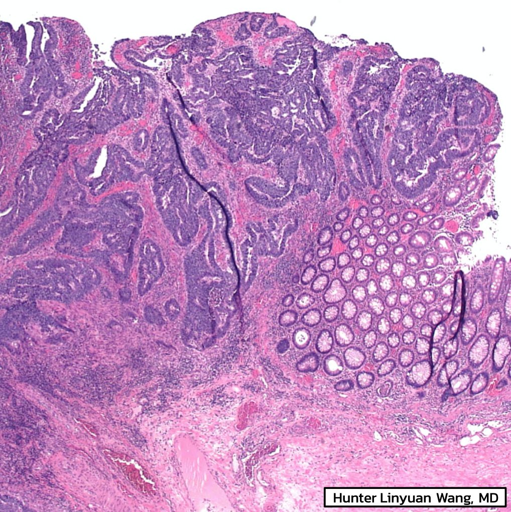EmoryPathology's tweet photo. EMORY CASE OF THE WEEK #30:

🔔 The next 2 cases will focus on colon pathology, in recognition of colon cancer awareness month

52F w/ unresectable colon polyp, diagnosed as adenocarcinoma on biopsy.

Contributor: Hunter L. Wang, MD

#EmoryCoTW #emorypathres #gipath #PathTwitter https://t.co/luSJqf59wD