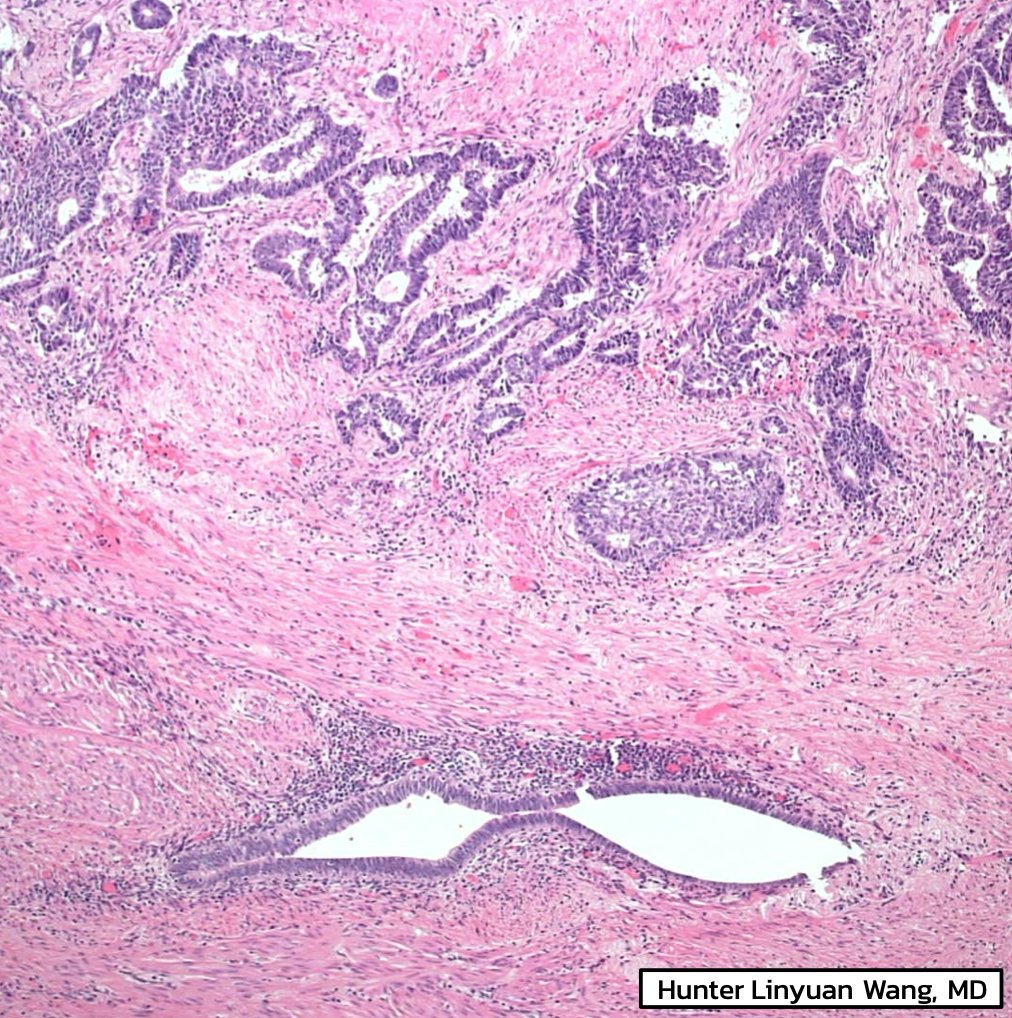 EmoryPathology's tweet photo. EMORY CASE OF THE WEEK #30:

🔔 The next 2 cases will focus on colon pathology, in recognition of colon cancer awareness month

52F w/ unresectable colon polyp, diagnosed as adenocarcinoma on biopsy.

Contributor: Hunter L. Wang, MD

#EmoryCoTW #emorypathres #gipath #PathTwitter https://t.co/luSJqf59wD