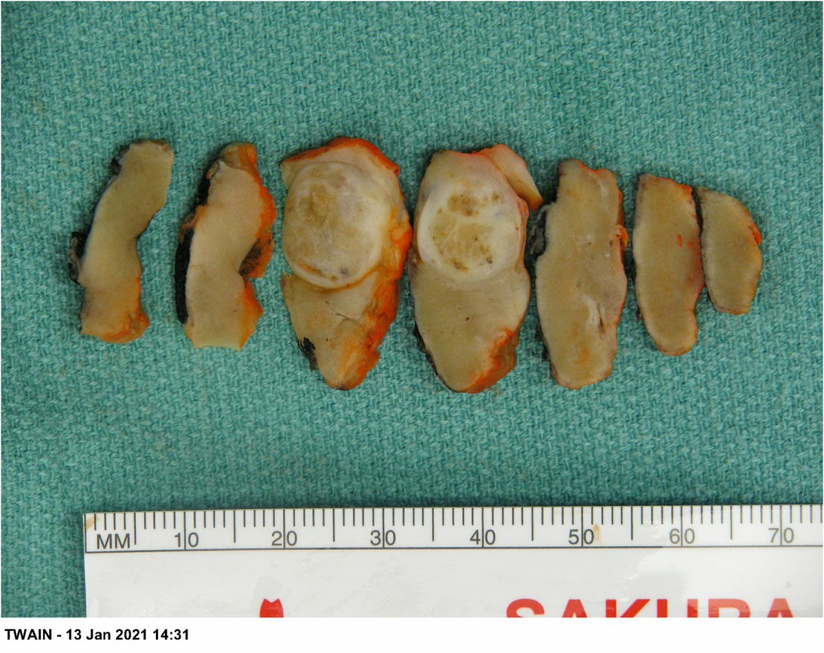 LaraHarikMD's tweet photo. Day #3 #Pathfun #Kidneycancerawarenessmonth
Inspired by @rovingatuscap
A little bit of a zebra but good gross correlation: (hind sight is 20/20 in my case)
what is the renal tumor subtype?
#GUPATH #Pathres #Pathology #surgpath https://t.co/JaEGKGD9ZC