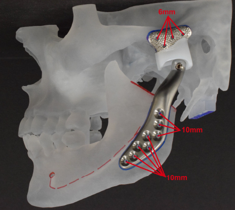 LukeCascarini's tweet photo. John had had synovial chondromatosis for about seven years, a rare benign but destructive tumour of the TMJ. I removed it and fitted a titanium (TMJ) replacement. I am so pleased he describes how he feels as “very, very good” https://t.co/ZS7fXElnPS. #TMJ #TMJreplacement https://t.co/iQWcsg7pv0