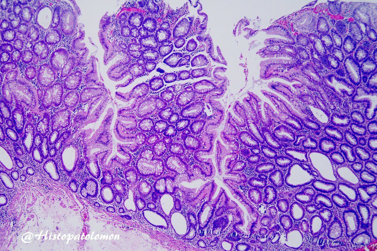 Histopatolomon's tweet photo. Dear #Gipath tweeples, how would you diagnose this colon polyp? #pathology #polyp #colonpolyp @vi_monappa @TeamCaptainJohn @RafaPinheiro_ @Pathmath1 @Mvgs1706 @Anthony10664419 @SSPgozaPath https://t.co/GDZLmloPIQ