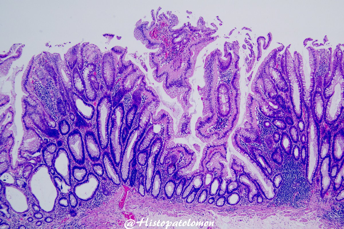 Histopatolomon's tweet photo. Dear #Gipath tweeples, how would you diagnose this colon polyp? #pathology #polyp #colonpolyp @vi_monappa @TeamCaptainJohn @RafaPinheiro_ @Pathmath1 @Mvgs1706 @Anthony10664419 @SSPgozaPath https://t.co/GDZLmloPIQ