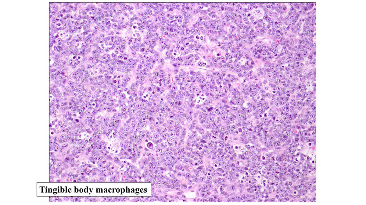 judith_ferry's tweet photo. Pathologists! Here’s a classic case of plasmablastic lymphoma presenting as colonic polyps. In addition to stains shown, HHV8 must be done to exclude HHV8+ DLBCL, particularly if patient is HIV+ or from endemic area (was negative in this case) #hemepath https://t.co/KwxzdTzwhI