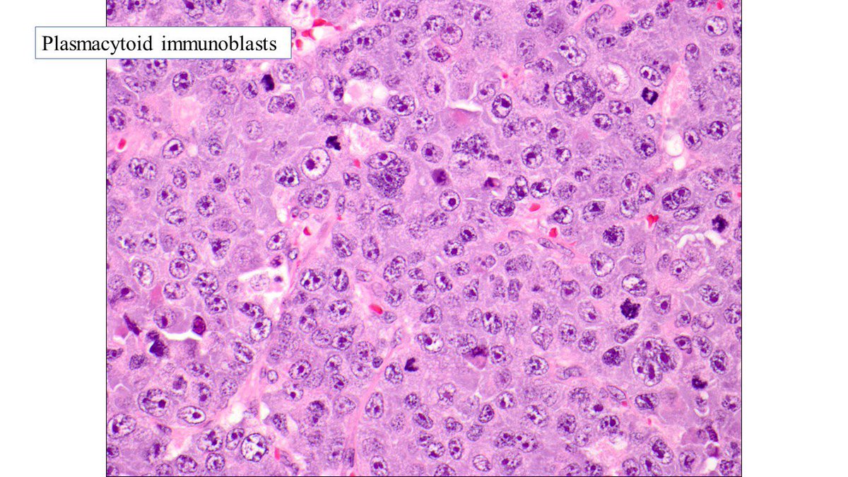 judith_ferry's tweet photo. Pathologists! Here’s a classic case of plasmablastic lymphoma presenting as colonic polyps. In addition to stains shown, HHV8 must be done to exclude HHV8+ DLBCL, particularly if patient is HIV+ or from endemic area (was negative in this case) #hemepath https://t.co/KwxzdTzwhI