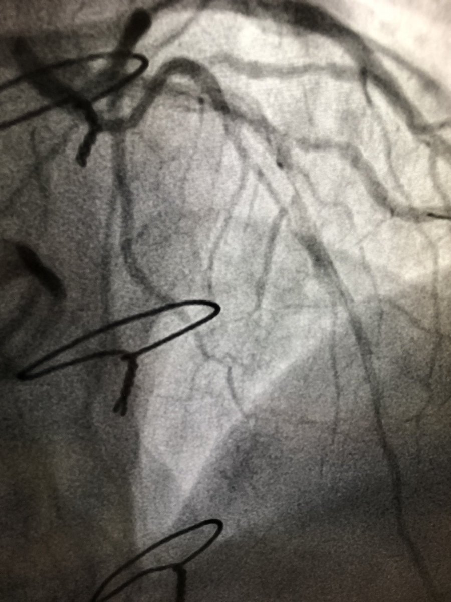 AntoineVaillier's tweet photo. 48 y - CTO LAD including Dg with viability in anterior - antegrade approach with double lumen microcatheter for recross the SB - DK crush 
-> DK crush for treatment of bifurcation CTO is useful to never remove the guide wire of the MB 👌@deharo_pierre @CuissetDr @aphm_actu https://t.co/mduzGrV913