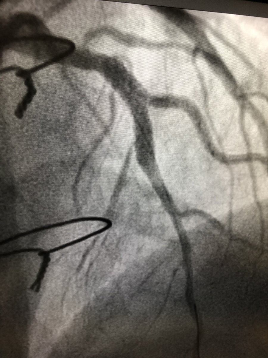 AntoineVaillier's tweet photo. 48 y - CTO LAD including Dg with viability in anterior - antegrade approach with double lumen microcatheter for recross the SB - DK crush 
-> DK crush for treatment of bifurcation CTO is useful to never remove the guide wire of the MB 👌@deharo_pierre @CuissetDr @aphm_actu https://t.co/mduzGrV913
