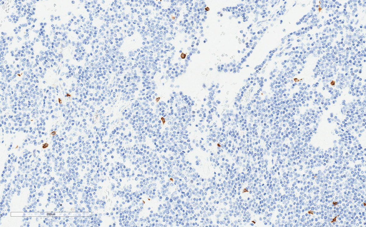 Gastric tumor. The two stains - left DOG1, right CD117. GIST anyone? #GIpath