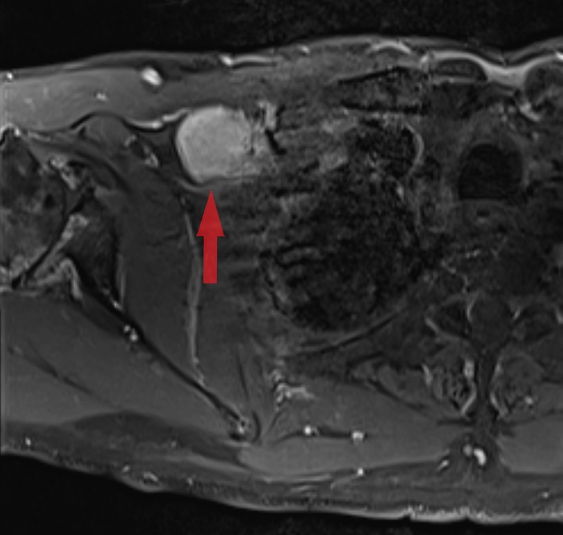 HubertLauMD's tweet image. 4 cm mass posterior to the pectoralis minor muscle. #CytoPath #FNApath (1/3)