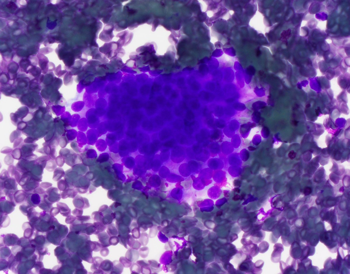 HubertLauMD's tweet image. 4 cm mass posterior to the pectoralis minor muscle. #CytoPath #FNApath (1/3)