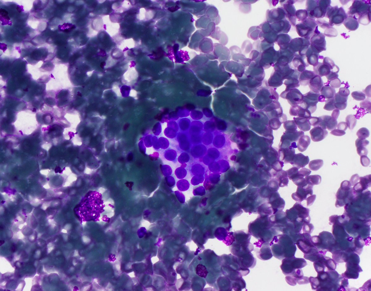 HubertLauMD's tweet image. 4 cm mass posterior to the pectoralis minor muscle. #CytoPath #FNApath (1/3)
