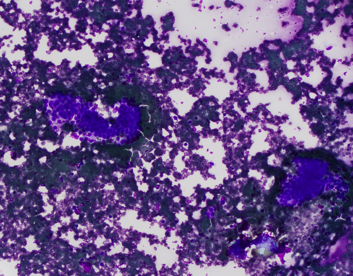 HubertLauMD's tweet image. 4 cm mass posterior to the pectoralis minor muscle. #CytoPath #FNApath (1/3)