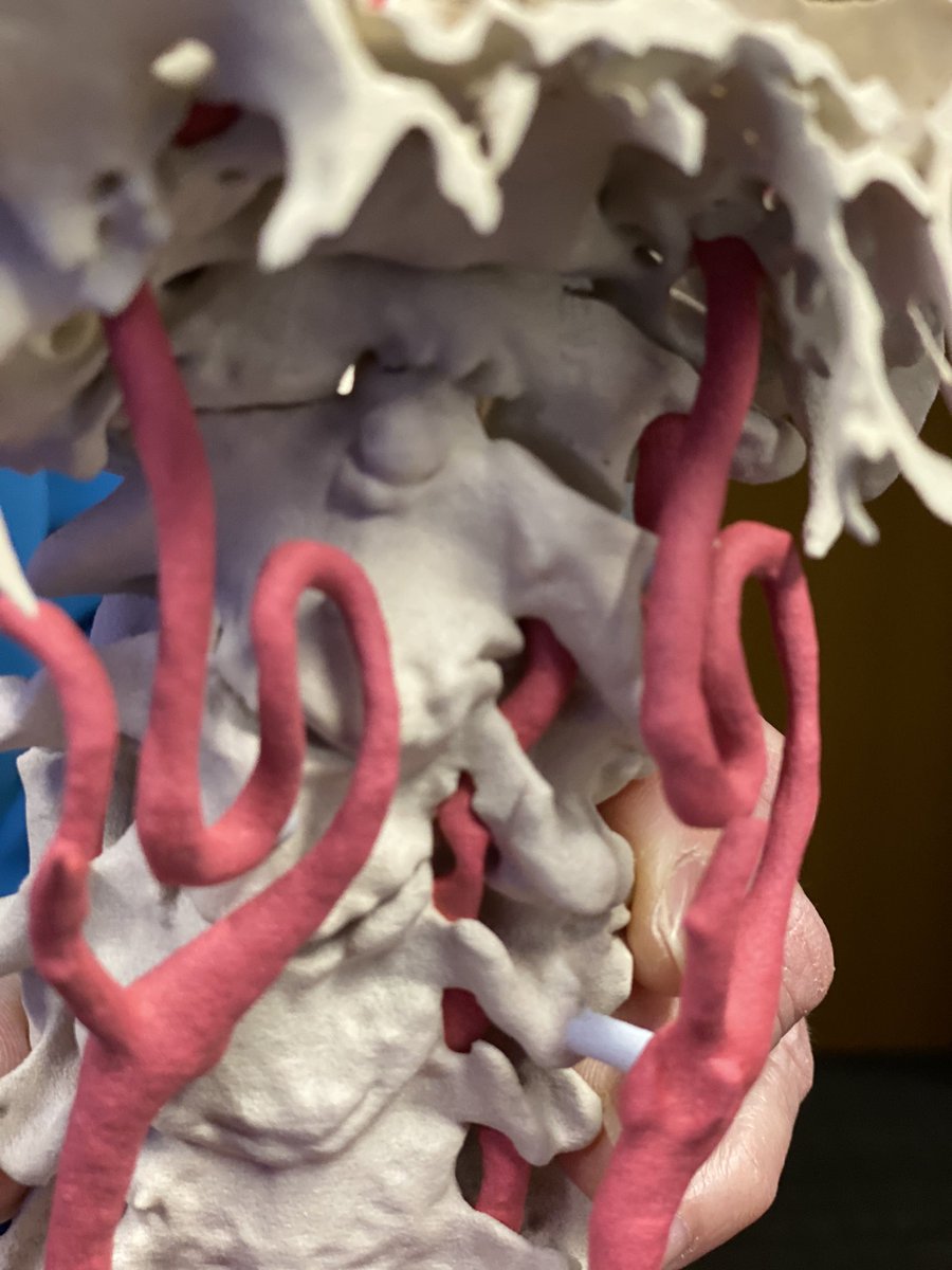 JayMorris_MD's tweet photo. When a #patient turns his head &amp; occludes #blood flow to the brain through the vertebral artery it is called #bowhunter syndrome. #3Dprinted spine models in turned &amp; neutral positions help w/ planning  #Neurosurgery #MondayMotivation #MedTwitter @MayoInnovation @MayoClinicSOM https://t.co/XDGoPhwUfW
