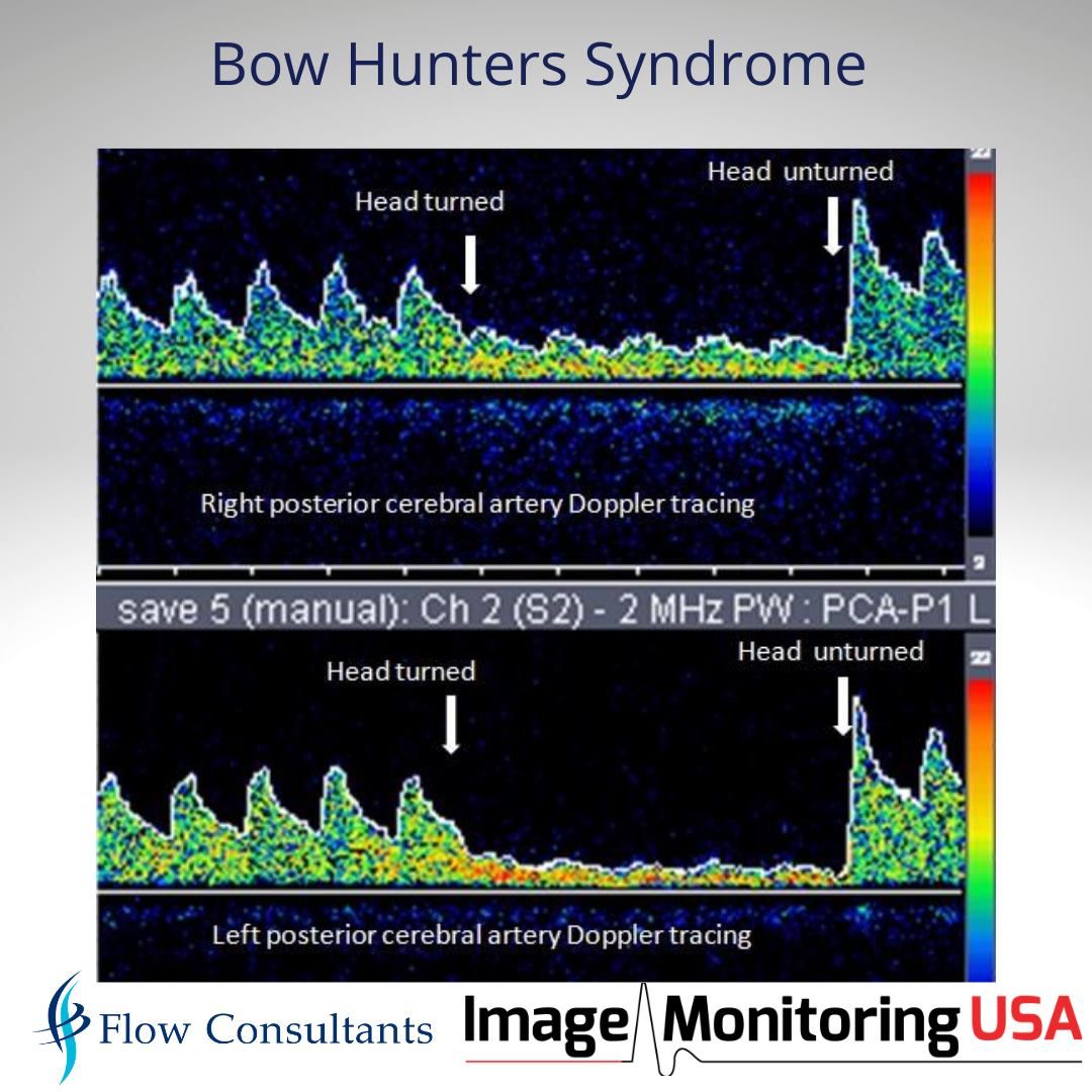 MonitoringUsa's tweet photo. See how Transcranial Doppler can easily diagnose Bow Hunters and Eagle Syndrome.
Click here https://t.co/CYJqS27o4x to read more!
#imusa #tcd #DolphinTCD #transcranialdoppler #bowhunters #eaglesyndrome https://t.co/JoKwdWl5Xt