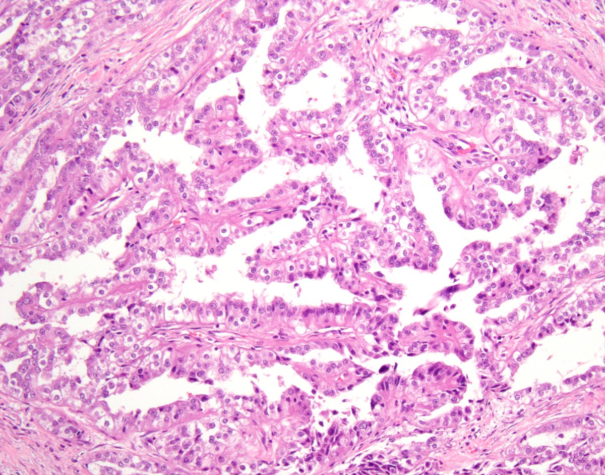 rovingatuscap's tweet photo. MITF Family Translocation-Associated RCC #1

TFE3 (Xp11.2) Rearranged 

🧬Onset in childhood &amp; younger age common
🧬Papillary w/clear cells
🧬Multiple partners w/TFE3 gene, incl. PRCC (1q21), ASPSCR1 (17q25), SFPQ (1p34)

#gupath #kidneycancer #KidneyCancerAwarenessMonth 1/ https://t.co/TYw0sVyhEs