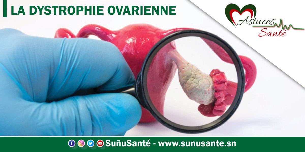 sunusante_sn's tweet image. 🛑 ASTUCE SANTE 

LA DYSTROPHIE OVARIENNE 

            Qu’est-ce que c’est ?

La dystrophie ovarienne est une maladie d’origine hormonale. Il s’agit d’un dérèglement hormonal caractérisé par une augmentation du volume des ovaires accompagnée de petits kystes en périphérie.