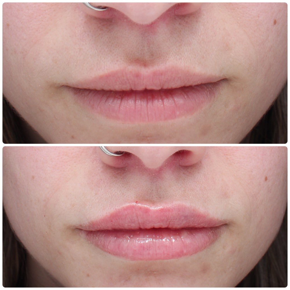 JeffreyCDawesMD's tweet image. Volume in all the right places. A subtle yet noticeable result! #lips #lipfiller #beauty #injectables #beforeandafter #filler #Hyaluronicacid #yycfiller #calgarylips