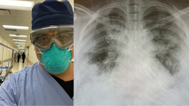 CTVNews's tweet photo. Toronto doctor shares images of lungs to show how COVID-19 is 'brutalizing' young people https://t.co/mCSIf7CTqe https://t.co/tzWTXAgwoQ