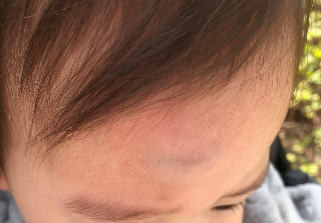 青あざ Twitter Search Twitter