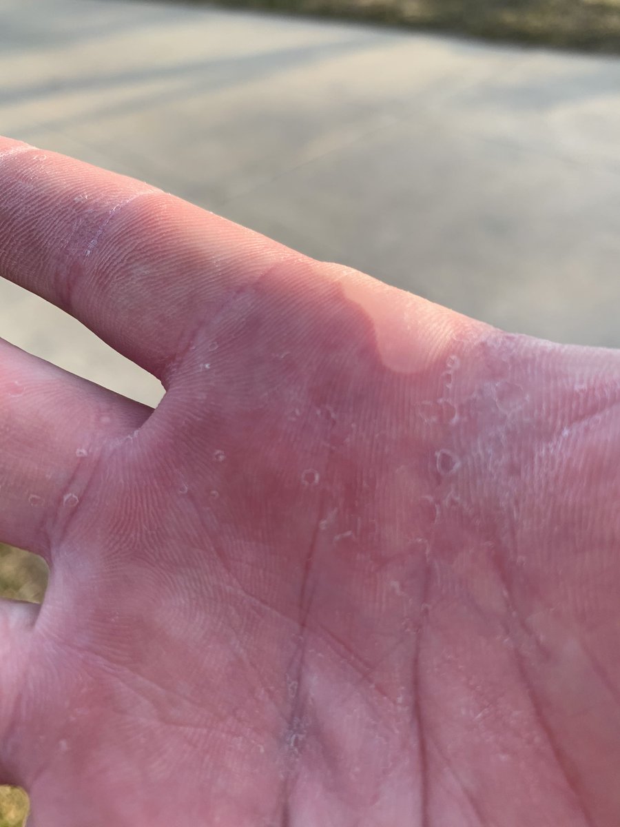 AdamsBaseball's tweet photo. Great day for tryouts on the baseball field for the first time in 17 years I think! Got the blister to prove it! #TheHighlanderWay! https://t.co/YuI7g6L0fe