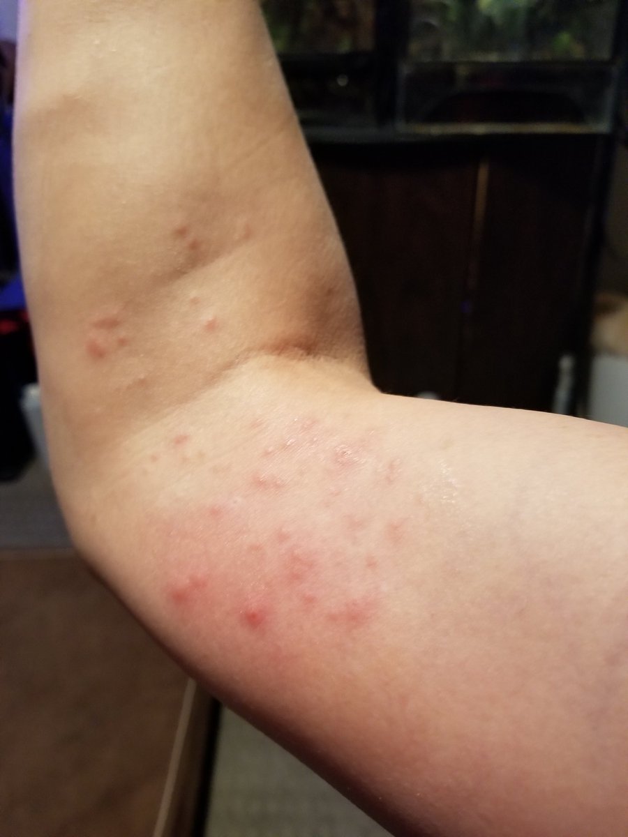 Mrs_Rips's tweet photo. I forgot where my anemone was in comparison to my arm during my most recent water change and she stung the shit outta me. #nofilter #saltwateraquarium #bubbletipanemone https://t.co/pmXvQ84nkk