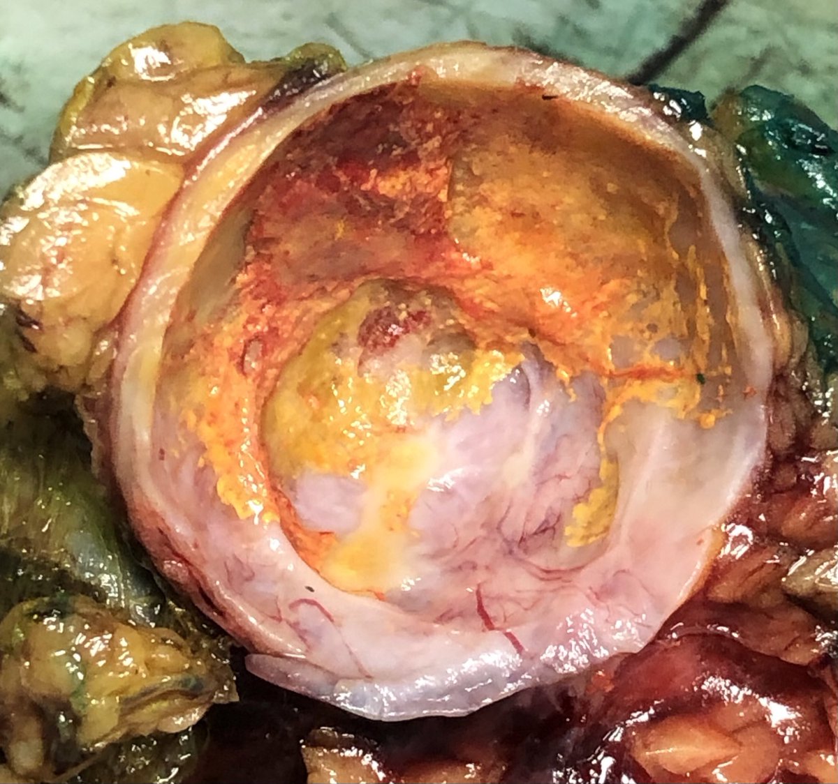 43 year old, female, distal pancreatectomy. No connection w ducts. Any guesses? #grossognosis #pancreas #cyst