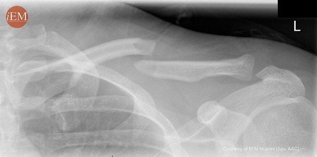 iem_student's tweet photo. "Upper extremity injuries" by Meltem Songur Kodik
#FOAMed #emergencymedicine #ICON360 #iEMstudent #ED #MedEd #medicalstudent #clerkship #EmergencyDepartment #Fracture #Disclocation #orthopedics #Pain #Shoulder #Elbow #Wrist #surgery 

Read full text: https://t.co/zVI0i4mHH5 https://t.co/PQgHnp7mcL