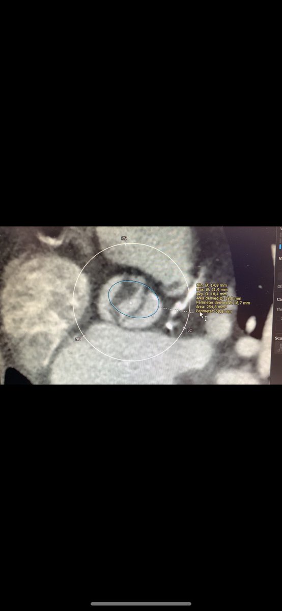 alaa__masri's tweet photo. #TAVI in bicupid aortic valve type 0 with elliptical annulus. 
Implantation  #PORTICO 23,with no AR and mean gradient at 15 mmHg
The only challenge was the cusp eversion after crossing the valve+severe AR+hemodynimc instability.Rapid deployment of the  #PORTICO solve the problem. https://t.co/EaYG5A28pT