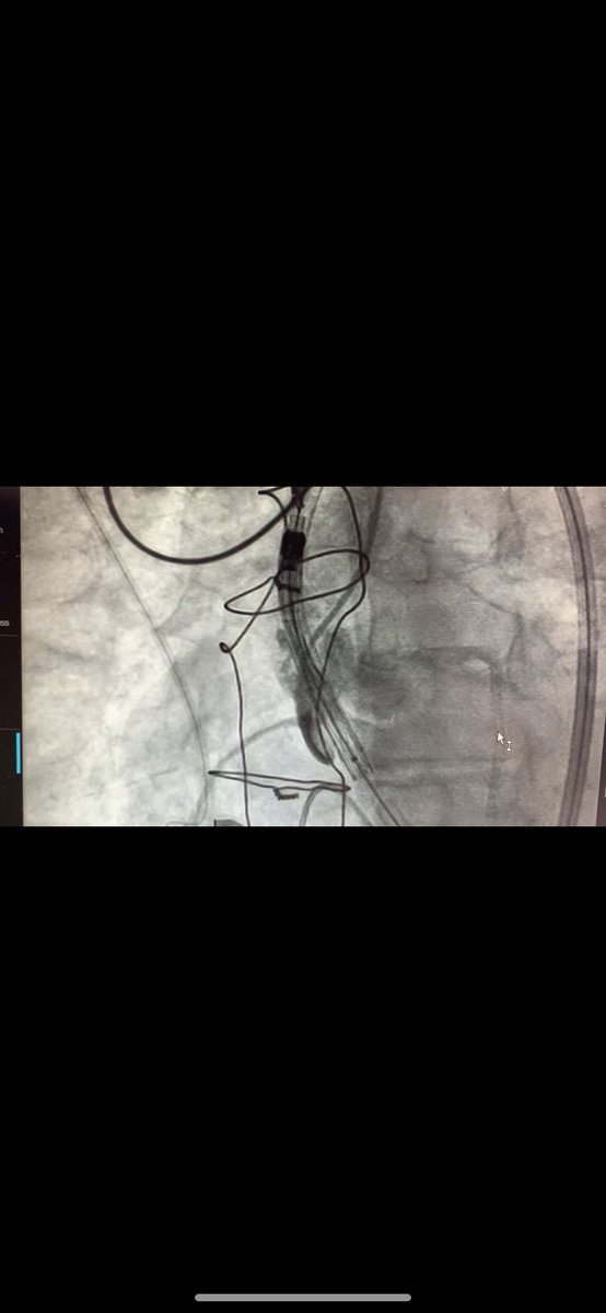 alaa__masri's tweet photo. #TAVI in bicupid aortic valve type 0 with elliptical annulus. 
Implantation  #PORTICO 23,with no AR and mean gradient at 15 mmHg
The only challenge was the cusp eversion after crossing the valve+severe AR+hemodynimc instability.Rapid deployment of the  #PORTICO solve the problem. https://t.co/EaYG5A28pT