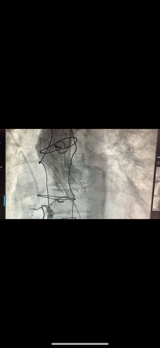 #TAVI in bicupid aortic valve type 0 with elliptical annulus. 
Implantation  #PORTICO 23,with no AR and mean gradient at 15 mmHg
The only challenge was the cusp eversion after crossing the valve+severe AR+hemodynimc instability.Rapid deployment of the  #PORTICO solve the problem.