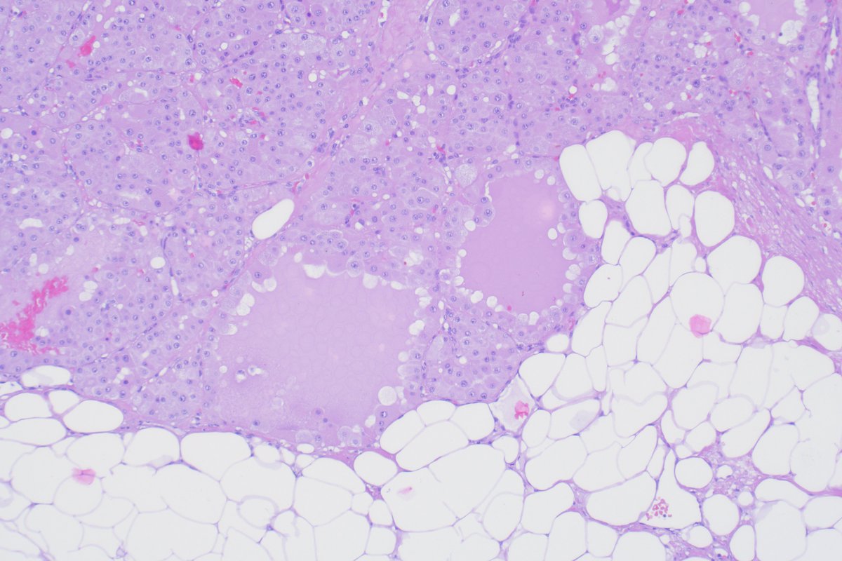 Still benin even if in contact with the perirenal fat oncocytoma #kidneytumor #gupath