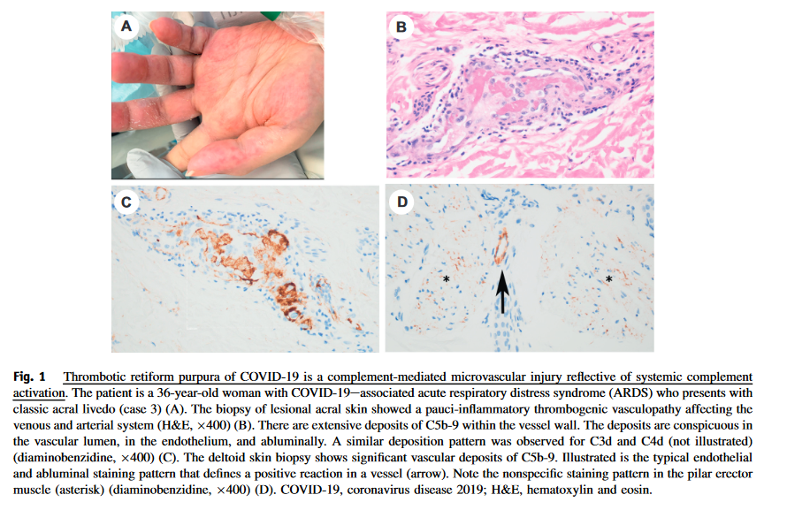 Human_Pathology's tweet photo. #MostDownloaded alert! #HumPathol
Magro et al. show that in severe #COVID19 colocalization of ACE2 & capsid proteins without viral RNA suggests that circulating viral proteins may dock onto microvascular endothelium and induce complement activation
https://t.co/iGWtuz4gJI https://t.co/bJ7UnIPp62
