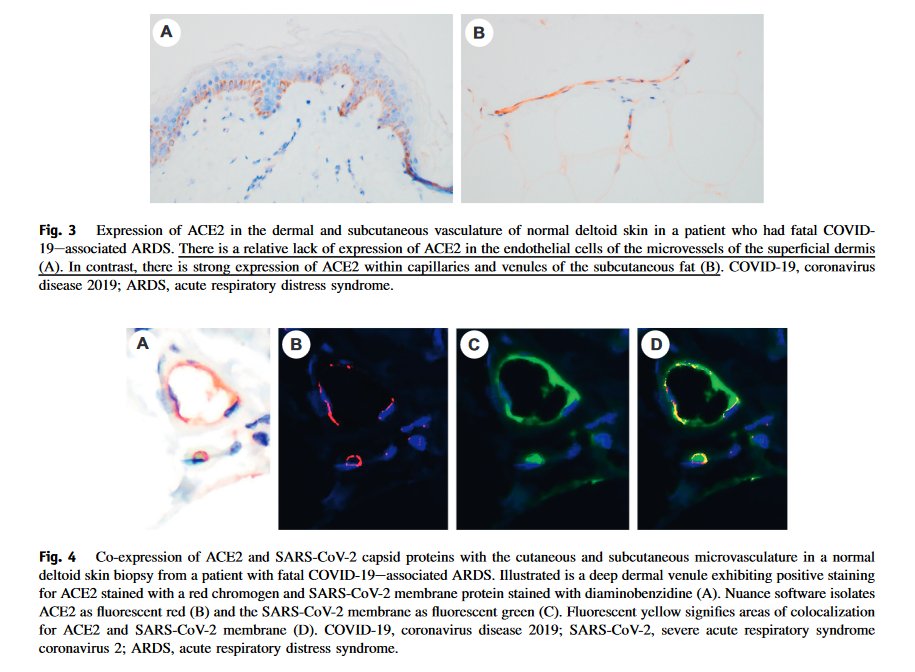 Human_Pathology's tweet photo. #MostDownloaded alert! #HumPathol
Magro et al. show that in severe #COVID19 colocalization of ACE2 & capsid proteins without viral RNA suggests that circulating viral proteins may dock onto microvascular endothelium and induce complement activation
https://t.co/iGWtuz4gJI https://t.co/bJ7UnIPp62