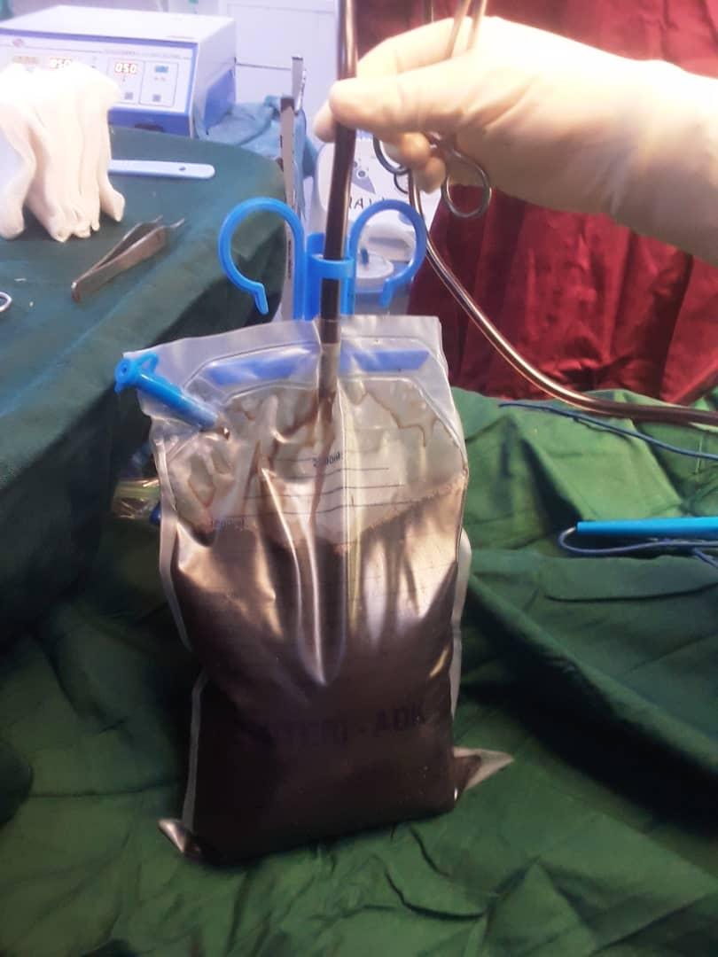 anniaramosperez's tweet photo. Is this the characteristic color of a Pancreatic fistula??🤔🤔🤔. Or the normal color of the content in a Pancreatic Pseudocyst???. This a 12 years old male patient.  10 weeks history of Epigastric blunt abdominal trauma. https://t.co/NYvaQvoEWx