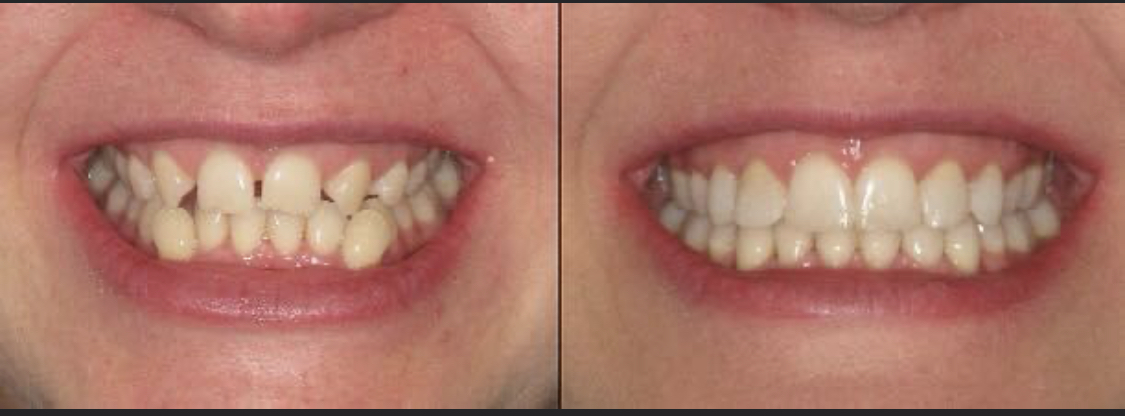 Going through my clinical photos and came across this case I completed soon after my year long restorative certificate course.  Orthodontics courtesy of Mark Tobin <a href="/TeethInLineMK/">Teeth-in-Line</a>