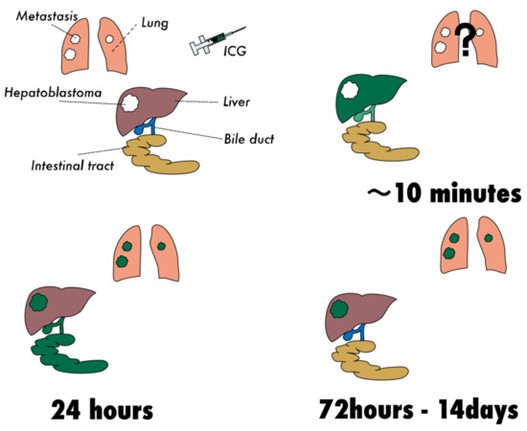 Cancers_MDPI's tweet photo. ➡️"Fluorescence-Guided Surgery for Hepatoblastoma with Indocyanine Green"
👥by Yohei Yamada, Michinobu Ohno et al.
👉https://t.co/CgaPNvhpvO
#hepatoblastoma #indocyanine_green #near_infrared @NICHD_NIH https://t.co/aMql1X3G9a
