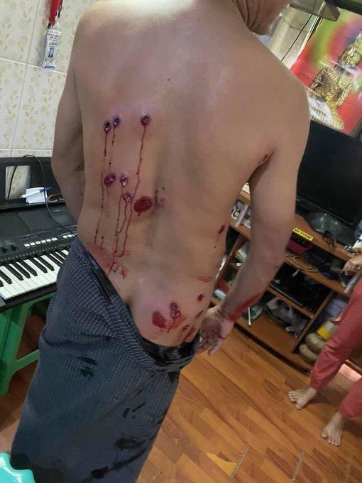 ZarniZenar's tweet photo. tw // blood // wound
A man got shot with at least 20 rubber bullets in Mandalay. Military junta forces are using all sorts of weapons from rubber bullets to heavy machine guns.
KEEP ON MOBILE DATA
#WhatsHappeningInMyanmar 
#Mar23Coup https://t.co/j14p6mLnKk