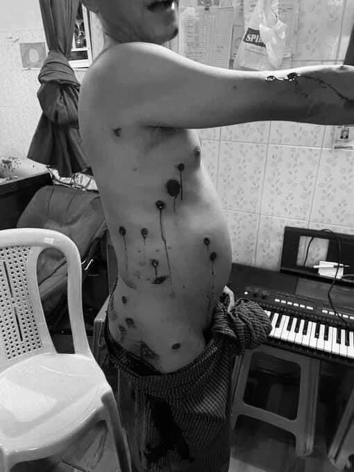 Tw // wound , blood 

Over 20 shots of rubber bullets fired against an unarmed citizen. Not one of us deserves this. These military thugs need to pay for every single thing they did. 
#WhatsHappeningInMyanmar 
#Mar23Coup 
KEEP ON MOBILE DATA