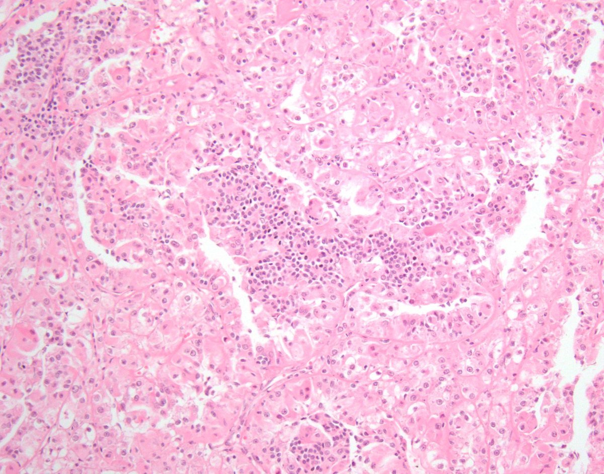 MITF Family Translocation-Associated RCC #2

TFEB (6p21) Rearranged 

🔬biphasic morphology: 
- larger epithelioid cells w/clear to eosinophilic cytoplasm
- smaller cells clustered around nodules of basement membrane material

#gupath #kidneycancer #KidneyCancerAwarenessMonth 1/