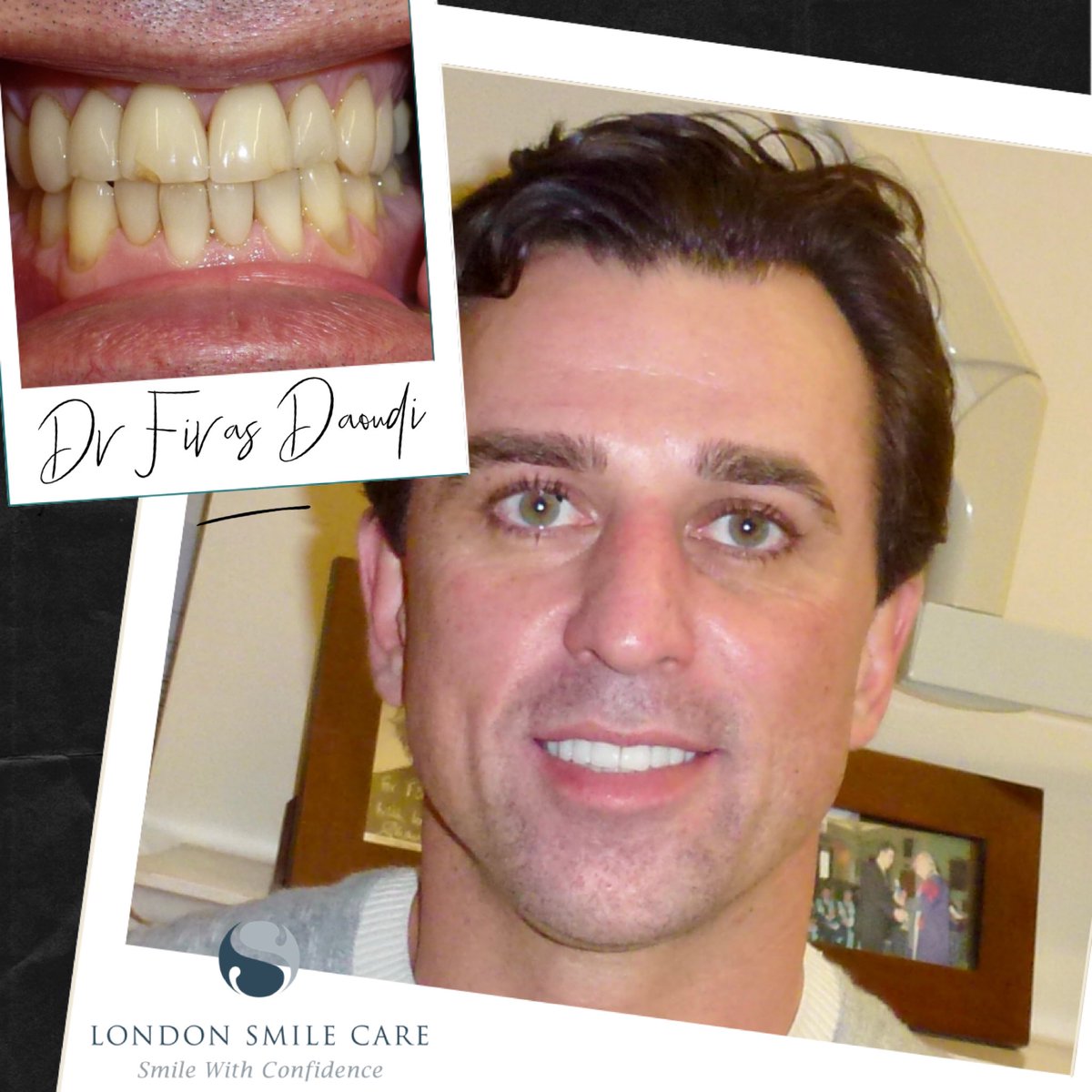 LondonSmileCare's tweet photo. New set of cosmetic #porcelainveneers can transform your smile!
The new veneers made to make the teeth whiter with careful attention to teeth shape masking sign of ageing and #toothwear resulting is fresher smile with #10yearsyounger effect.
Contact our #specialistcosmeticdentist https://t.co/0ITxsV6wff