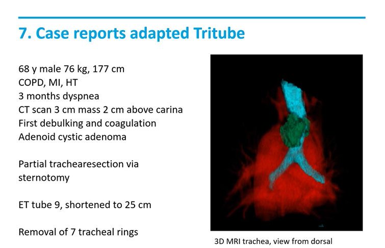 Last weeks webinar presented by Dr. Jo Mourisse and Drs. Marieke Kuut about Ventilation through Tritube for tracheal resections can now also be viewed via in the following link: ventinovamedical.com/webinars/