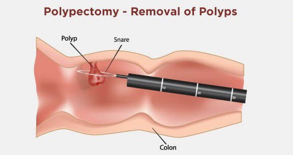 Did you know that colonoscopy is the only cancer screening procedure that can actually cure the cancer it is screening for? Remove a pre-cancerous polyp, cure colon cancer.