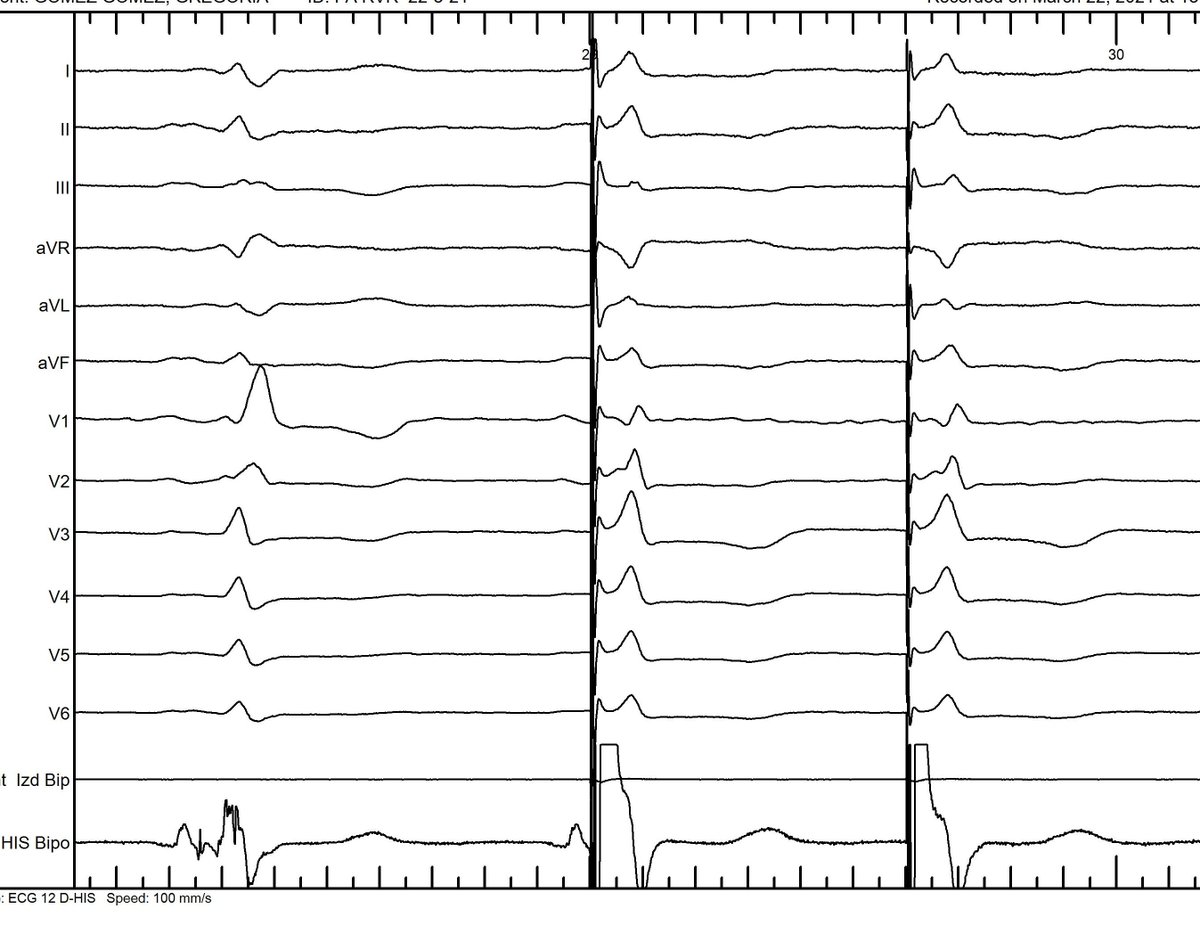 Medtronic deflectable 304 His, allowed us HBP, correcting a preexisting RBBB. The HB electrogram could not be recorded with non-steerable sheath. Patient suffered from pulmonary HT and persistent AF without rate control despite high dose of drugs. AVN ablation proposed.