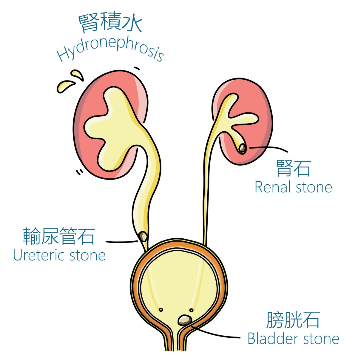 [#CUHKUrology] 🕵️🩺PCNL is a minimally invasive surgery to remove kidney stones. It involves the passing of a medical instrument through the skin into your kidney to remove the stones. 
Details: bit.ly/3rWNB1D