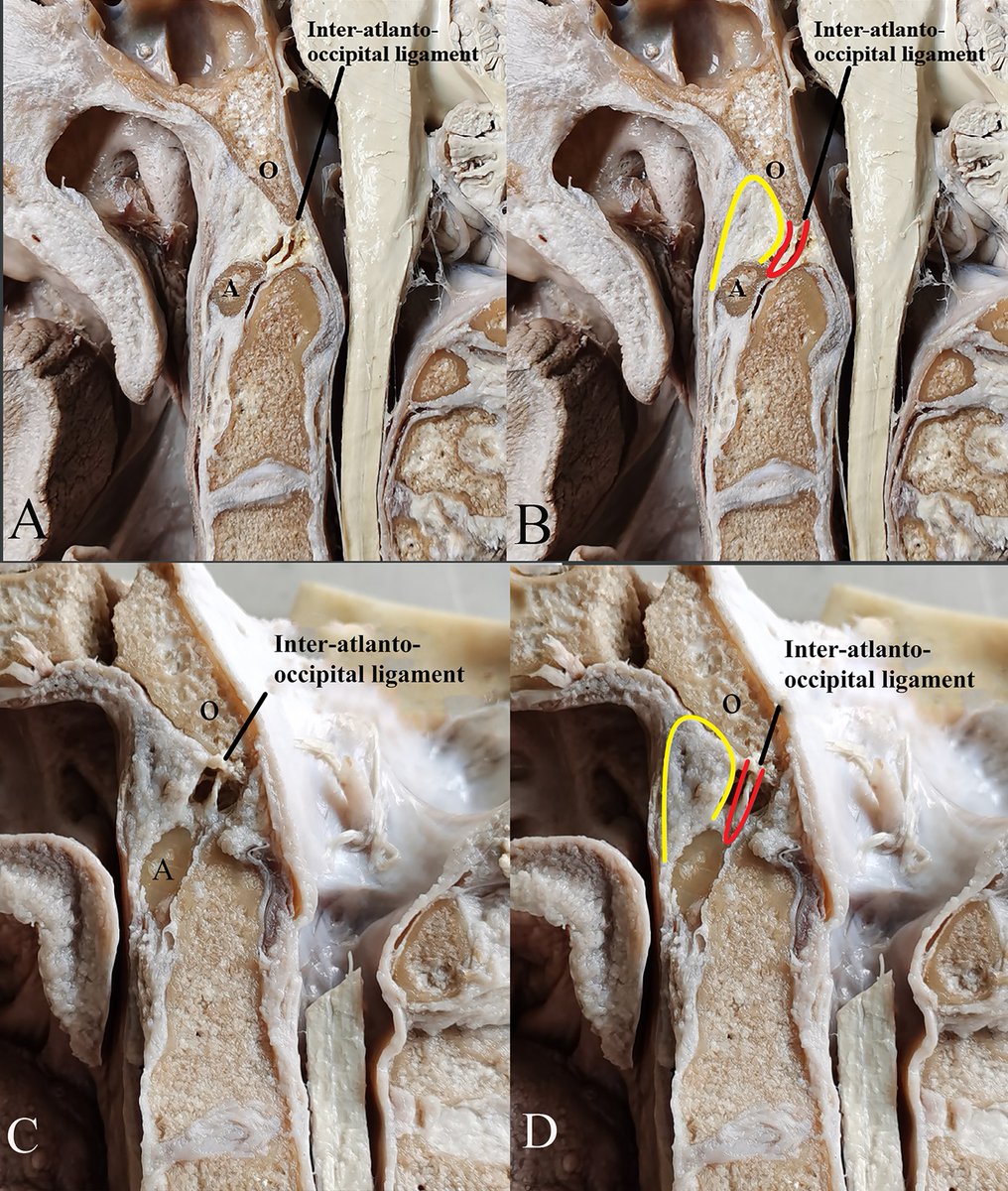 Clinorthop's tweet image. Knowledge of an unrecognized #ossification in the craniocervical junction, what the authors call the capped dens sign, may improve the diagnosis and treatment of craniocervical stability and dislocation.
#spine #ortho #cervicalspine
📖 ow.ly/jzG350E5zse