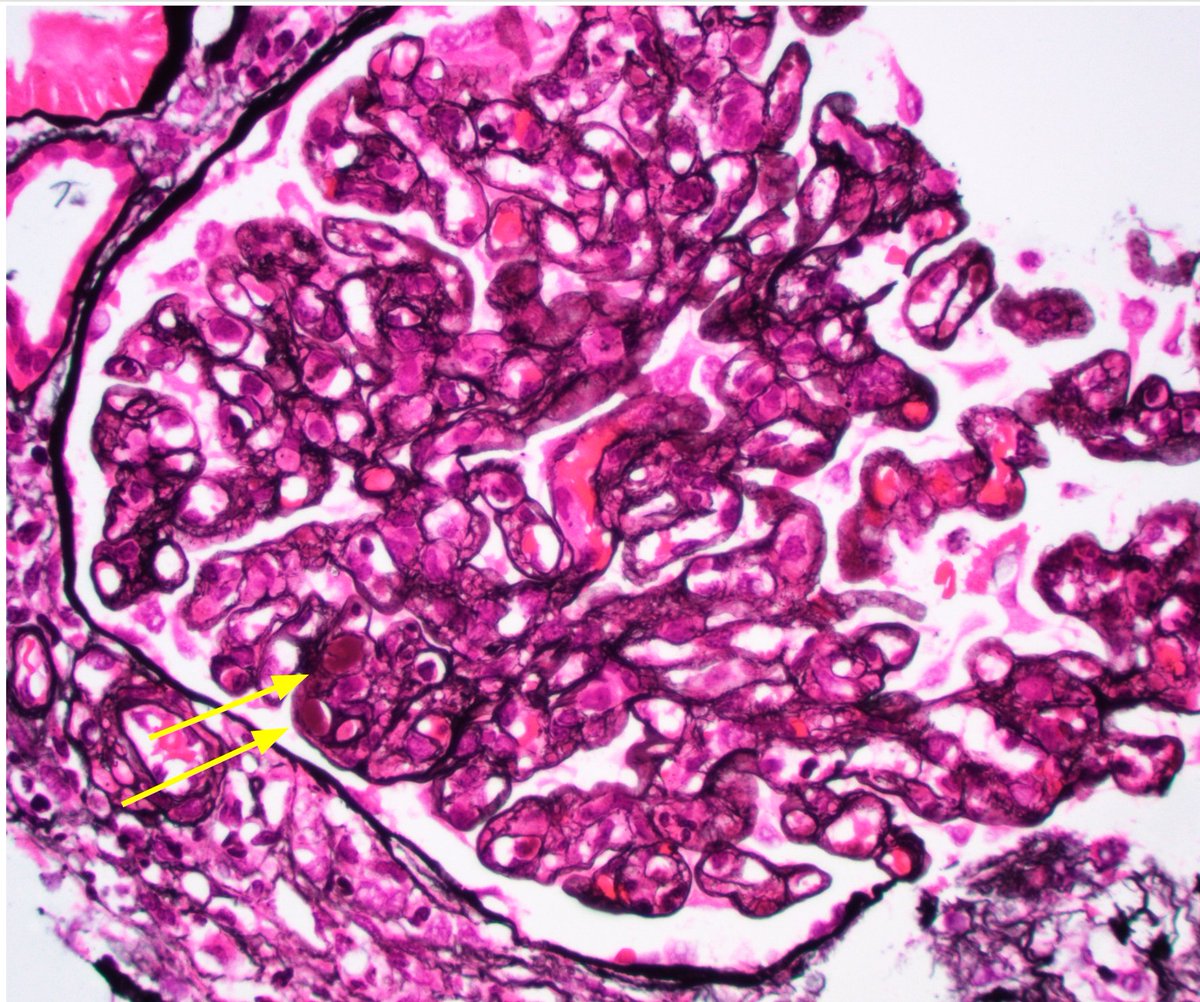 JZRenalPath's tweet photo. Biopsy for acute kidney injury in pt with hx of sjogren. MPGN pattern with segmental hyaline pseudothrombi, IgM dominant staining, and deposits with short microtubular substructure. Arteritis with cyro deposits also present. #renalpath #nephropath https://t.co/4HIyRvGvW1