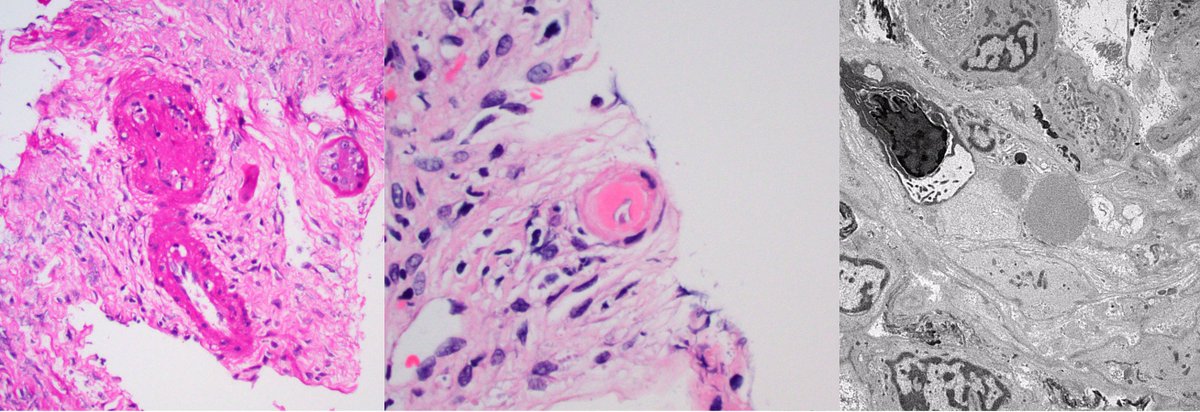 JZRenalPath's tweet photo. Biopsy for acute kidney injury in pt with hx of sjogren. MPGN pattern with segmental hyaline pseudothrombi, IgM dominant staining, and deposits with short microtubular substructure. Arteritis with cyro deposits also present. #renalpath #nephropath https://t.co/4HIyRvGvW1