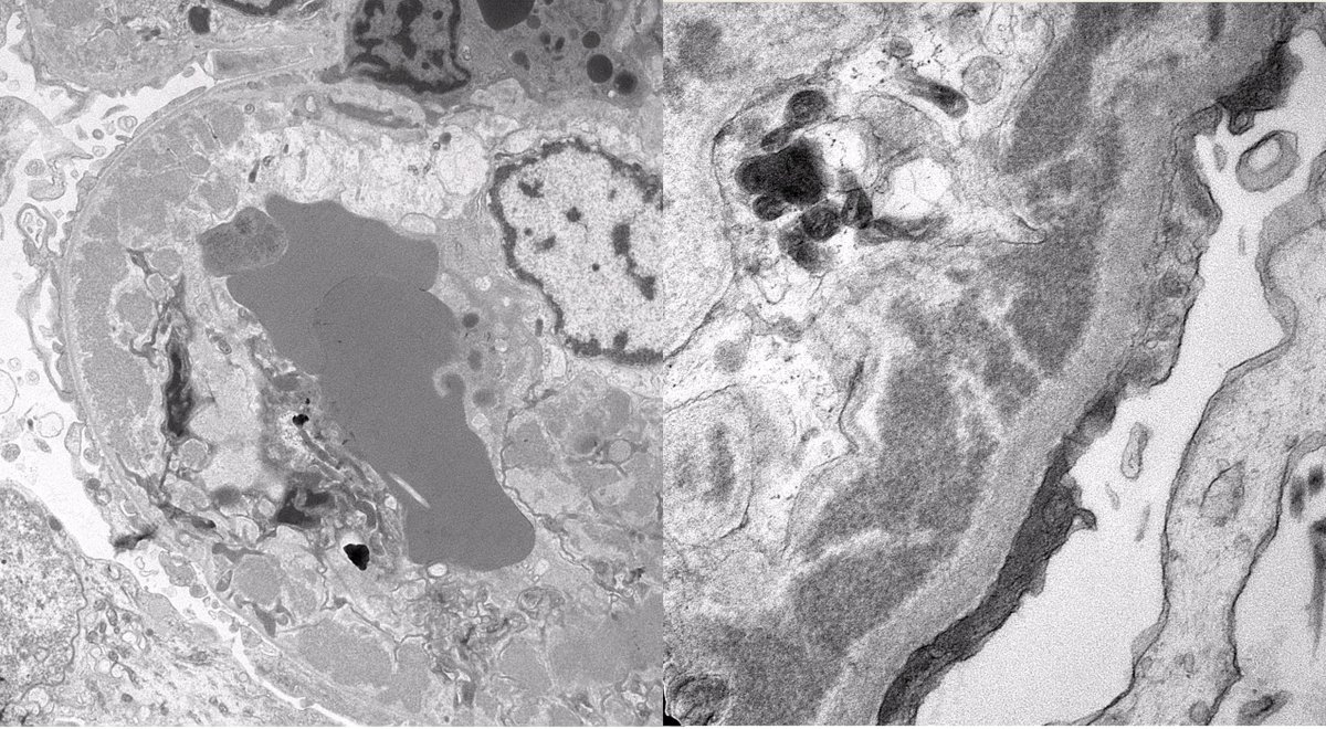 JZRenalPath's tweet photo. Biopsy for acute kidney injury in pt with hx of sjogren. MPGN pattern with segmental hyaline pseudothrombi, IgM dominant staining, and deposits with short microtubular substructure. Arteritis with cyro deposits also present. #renalpath #nephropath https://t.co/4HIyRvGvW1