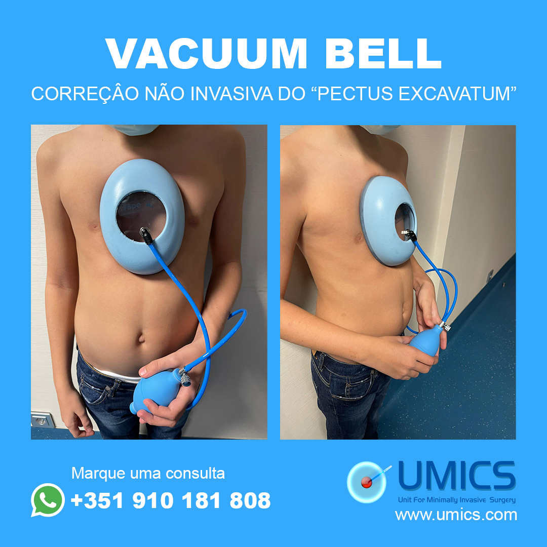 UmicsSurgery's tweet photo. O Vacuum Bell usa uma ventosa, criando uma vedação a vácuo na parede torácica e levantando o esterno, corrigindo assim o Pectus Excavatum
Para saber mais, ligue para a UMICS através do Whatsapp +351 910 181 808 ou em https://t.co/i1lYwuhgZF

#pectusexcavatum #vacuumbell #umics https://t.co/R4iHFDPYFK