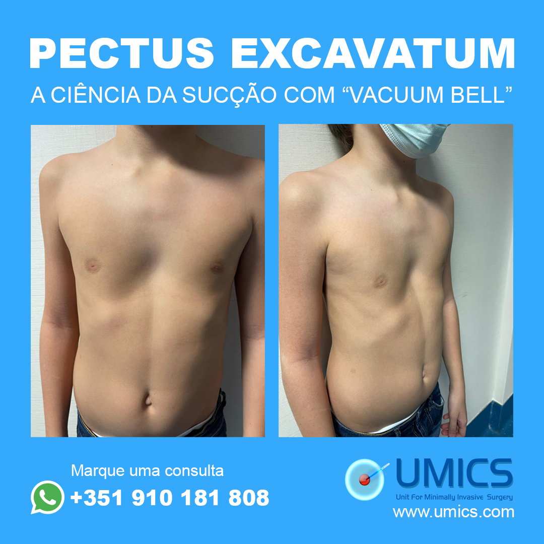 UmicsSurgery's tweet photo. O Vacuum Bell usa uma ventosa, criando uma vedação a vácuo na parede torácica e levantando o esterno, corrigindo assim o Pectus Excavatum
Para saber mais, ligue para a UMICS através do Whatsapp +351 910 181 808 ou em https://t.co/i1lYwuhgZF

#pectusexcavatum #vacuumbell #umics https://t.co/R4iHFDPYFK