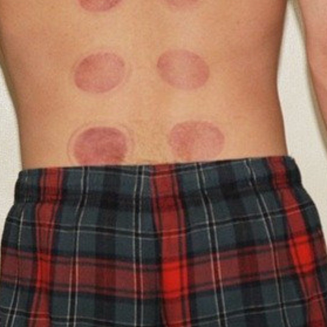 MendColo's tweet photo. No Difference Between Cupping And Placebo For Patients With Chronic Low Back Pain
https://t.co/ID7Bj5Hv7J https://t.co/wJ2OqwBAsZ